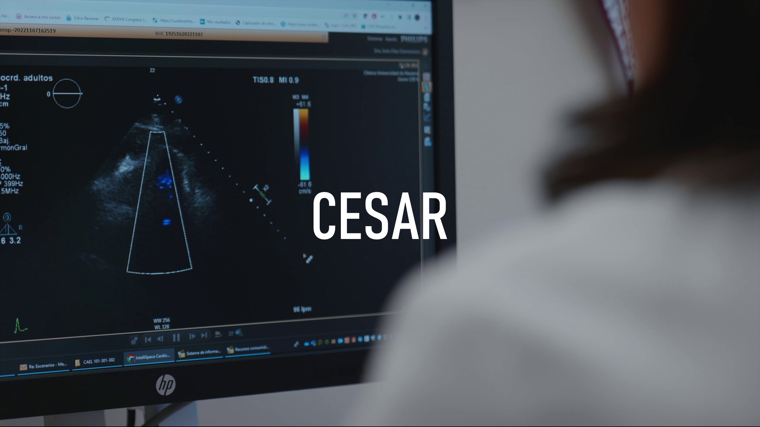 Proyecto colaborativo CESAR - investigación daños cardíacos Covid-19